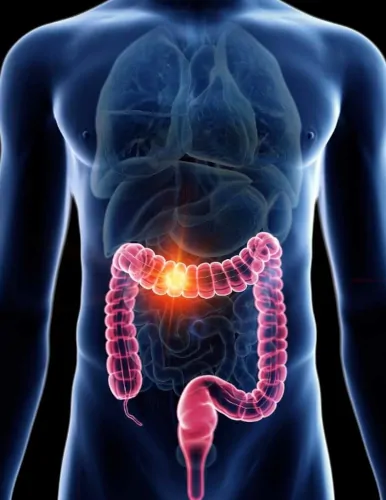 Entzündung im Dünndarm Entzündung im Dünndarm